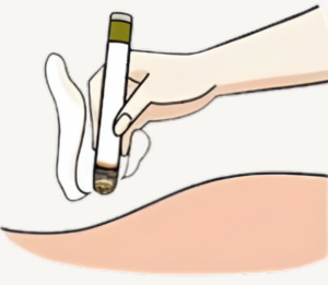 Moxibustion Technique, Moxibustion therapy along acupuncture